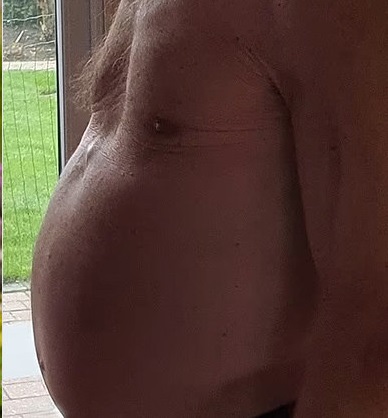 tumor melancia