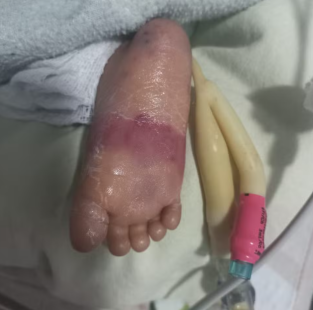 queimadura bebe